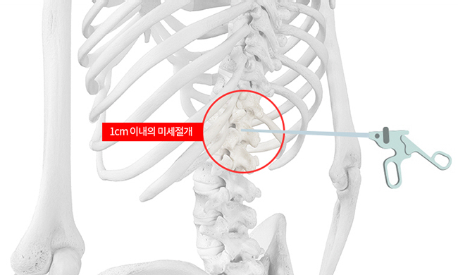 내시경 척추관협착증 수술이미지