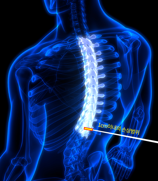 내시경 척추관협착증 수술증상이미지